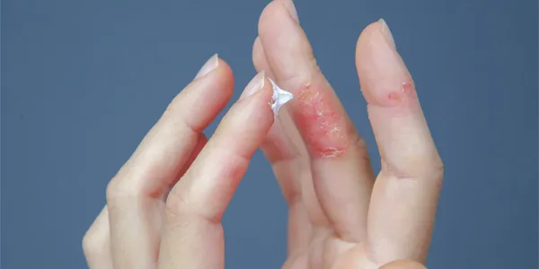 Dłonie dotknięte atopowym zapaleniem skóry aplikują krem łagodzący